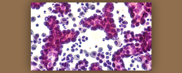 Non-small cell lung cancer cells