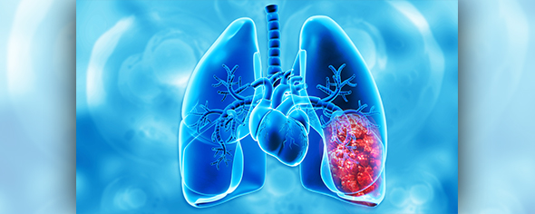Illustration of X-Ray of lung cancer tumor