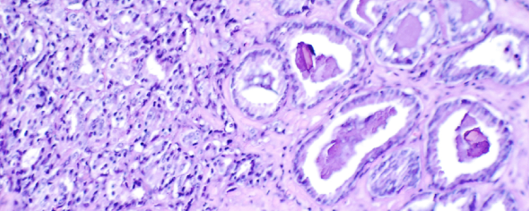 Prostate cancer cells, histology slide