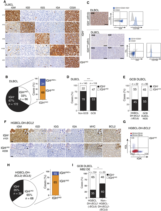 IGH silencing in GCB DLBCL and HGBCL-DH-BCL2. A, Class-specific IGH IHC analysis of representative DLBCL cases (n = 258), including an IGHUND case (last row). CD20 expression and scattered IGH immunoreactivity from infiltrating plasma cells act as internal staining controls. B, Distribution of IGH+ and IGHUND lymphomas among consecutive DLBCL cases (n = 258). The IGHUND group includes a fraction of IGHUND/+ mixed lymphomas. Numbers inside bars indicate frequencies. C, IGH IHC matched to FACS measurements of surface IGK, IGL, and CD79B expression in representative IGH+ and IGHUND DLBCL (n = 30). Tumor B cells are labeled in blue. CD20− non-B cells (gray) act as negative controls. D, Frequencies of IGH+ and IGHUND cases among DLBCLs grouped for COO according to the Hans algorithm. Numbers above histograms refer to cases. E, Frequencies of IGH+ and IGHUND cases among HGBCL-DH-BCL2(-BCL6) and GCB DLBCL NOS cases. Number of cases is indicated above histograms. F, Class-specific IGH, MYC, and BCL2 IHC in representative IGH+ and IGHUND HGBCL-DH-BCL2 (n = 104) with rare infiltrating plasma cells acting as internal IGH staining control. G, Flow cytometric analysis for surface IGK and IGL expression in a case of IGHUND HGBCL-DH-BCL2. Percentage of gated tumor (red) and normal (blue) B cells are shown. H, Frequencies of IGH+ and IGHUND cases among HGBCL-DH-BCL2(-BCL6) in a cohort of n = 104 nonconsecutive cases. The IGHUND group includes a minor fraction of IGHUND/+ lymphomas (blue). I, Frequencies of IGH+ and IGHUND cases among GCB MB2 DE DLBCLs, grouped according to the presence (HGBCL-DH-BCL2) or absence (non-HGBCL-DH-BCL2) of BCL2 and MYC rearrangements. Number of cases is indicated above histograms. Scale bars, 20 μm (A), 100 μm (C), and 80 μm (F). Insets in (F) refers to sections photographed at low (top left, 3.8 and 7 mm scale bars in the IGH+ and IGHUND panels, respectively) and high (top right, 10 μm scale bar) magnification. P values (D and I) were determined by the Fisher exact test: **, P < 0.01; ***, P < 0.001.