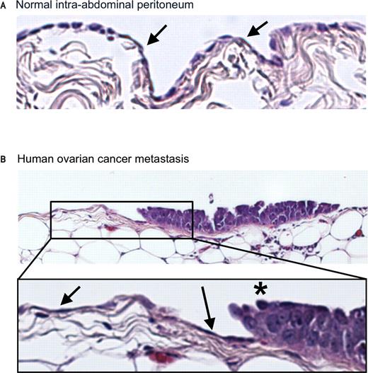 Figure 1. Ovarian cancer cell metastasis. Hematoxylin and eosin-stained human peritoneal surface from a cancer-free patient (A) and a microscopic tumor implant on the omental surface from a patient with metastatic serous ovarian carcinoma (B). Mesothelial cells (arrows) line the abdominal surface but are not detected under the proliferating ovarian cancer cell implant (asterisk).