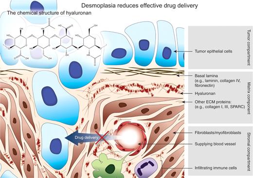 Figure 1. Invading epithelial tumor cells and the associated tumor microenvironment. Dissolution of the basement membrane is accompanied by the production and secretion of numerous ECM components, including the collagens, fibronectin, laminin, and HA, as part of the myofibroblast-mediated desmoplastic reaction. Infiltrating immune cells also contribute to the signaling involved in the desmoplastic reaction. Expansion of the stromal compartment and production of the ECM proteins are thought to result in greater intratumoral pressure and contribute to a reduction in effective drug delivery. Inset, chemical structure of HA. HA is a linear polysaccharide composed of repeating units of glucuronic acid and N-acetylglucosamine. HA is a nonsulfated GAG and participates as an integral component of the ECM.