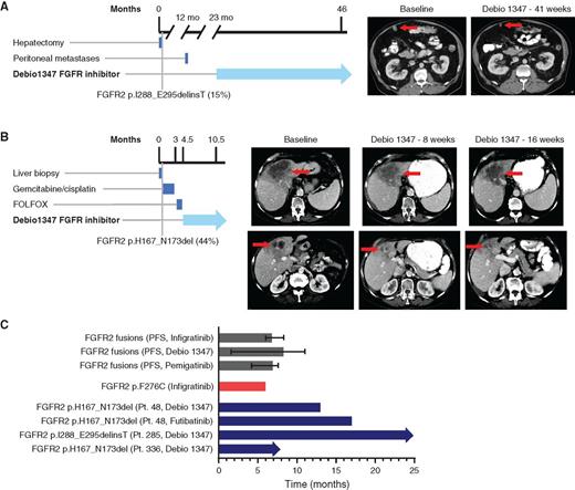 Figure 4. Patients with FGFR2 EIDs have prolonged clinical responses to FGFR inhibitors. A, Timeline and CT scans demonstrating patient 285′s peritoneal lesion at baseline and after 41 weeks of Debio 1347 treatment. B, Timeline and CT scans demonstrating patient 336′s liver mass at baseline and after 8 and 16 weeks of treatment with Debio 1347. C, Bar graph depicting median PFS of patients with cholangiocarcinoma harboring an FGFR2 fusion treated with infigratinib (17), Debio 1347, and pemigatinib (3). Error bars indicate 95% confidence intervals. Graph also shows time on treatment for a patient with cholangiocarcinoma with an FGFR2F276C extracellular domain mutation who was treated with infigratinib (41), and time on treatment for three IHCC FGFR2 EID patients described in this article. Arrows indicate that treatment is ongoing.