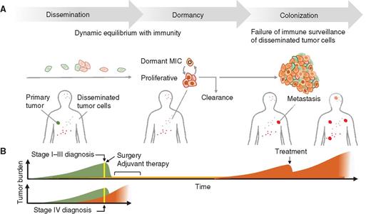 Figure 1. Phases of metastasis. A, Metastasis proceeds through three distinct phases of dissemination, dormancy and colonization. MICs disseminate from the primary tumor and seed multiple organs, where they enter a subclinical state of dormancy. During dormancy, MICs may shuttle between quiescent and proliferative states, with proliferative cells being continually cleared by niche-specific or systemic immune defenses. MICs that acquire immune-evasive and organ-specific growth adaptations are able to exit dormancy and generate clinically evident macrometastatic colonies. During dissemination and dormancy, MICs are in a dynamic equilibrium with host immunity, whereas failure of immune surveillance results in metastatic outbreaks and organ colonization. B, The three phases of metastasis can overlap with the growth of primary tumors and may coexist in the same individual until removal of the primary tumor (stages I–III). The latter two phases continue to coexist during adjuvant therapy, with the eventual dominance of the colonization phase resulting in macrometastatic relapse (in cases that were originally diagnosed as stage I–III), or in patients diagnosed with de novo stage IV cancers.