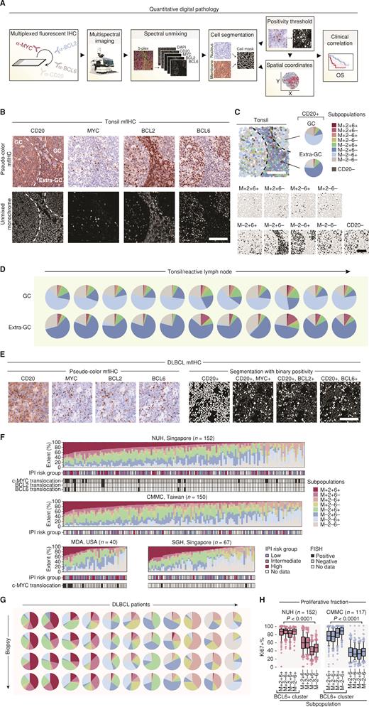 Figure 1. Quantitative single-cell analysis of MYC, BCL2, and BCL6 protein expression in B cells in nonmalignant tissues and diffuse large B-cell lymphoma. A, Schematic workflow of a quantitative digital pathology experiment. B, Spectrally unmixed multiplexed fluorescent images for CD20, MYC, BCL2, and BCL6 and nuclear counterstaining in tonsil tissue. The germinal center (GC) and extragerminal center (extra-GC) zones are indicated. C, Spatial map of MYC/BCL2/BCL6 subpopulations, i.e., possible permutations of MYC/BCL2/BCL6-positivity and -negativity within the CD20-positive cell population in a tonsil image. D, Quantitation of subpopulation extent within CD20-positive cells in tonsils and reactive lymph nodes resolved spatially between the GC and extra-GC zones. E, Example of pseudocolored MYC/BCL2/BCL6/CD20 mfIHC staining in diffuse large B-cell lymphoma (DLBCL; left). Cell segmentation and single oncogene positivity masks are shown within the CD20-positive cell population (right). F, Summary of percentage extent of subpopulations across patients from National University Hospital (NUH), Chi-Mei Medical Center (CMMC), MD Anderson (MDA), and Singapore General Hospital (SGH). Relevant clinicopathologic features are indicated; see also Supplementary Fig. S3. Patients were ordered arbitrarily according to extent of the triple-positive M+2+6+ subpopulation extent. IPI Risk Group, International Prognostic Index Risk Group; FISH, fluorescence in situ hybridization. G, Intrapatient spatial stability of subpopulations – proportion of subpopulations measured across four spatially distinct biopsies from the same patient (rows). Biopsy comparison overview is shown across 11 representative example DLBCL patients (columns). See also Supplementary Fig. S4A and S4B for a correlation analysis for all patients with multiple biopsies available. H, Proliferation analysis (i.e., Ki-67-positivity) among subpopulations in DLBCL samples. Proliferative BCL6-positive subpopulations are grouped. Median with interquartile range, whiskers denote 10th and 90th percentile. Mann–Whitney test (BCL6-positive vs. -negative subpopulations). All scale bars, 100 μm.