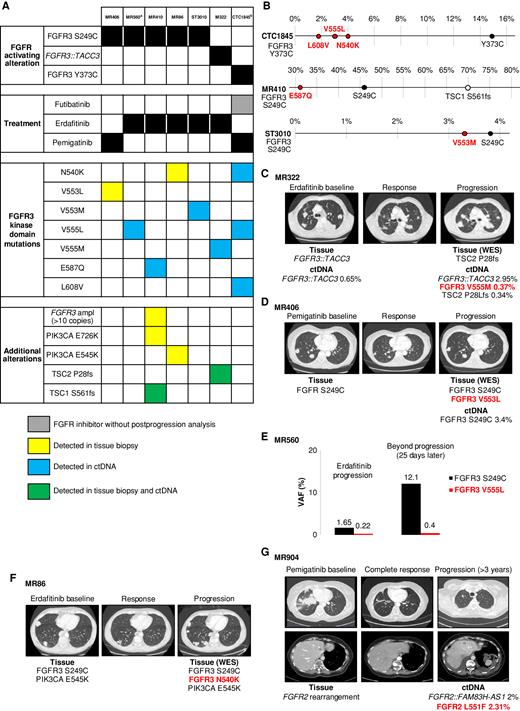 Resistance to Selective FGFR Inhibitors in FGFRDriven Urothelial