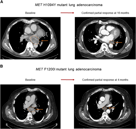 Antitumor activity of MET inhibitor in two patients with NSCLC harboring MET TKD mutations. Confirmed partial response achieved with the type Ib MET inhibitor elzovantinib (TPX-0022) in A a 64-year-old man with MET H1094Y mutant lung adenocarcinoma and in B an 80-year-old man with MET F1200I mutant lung adenocarcinoma.