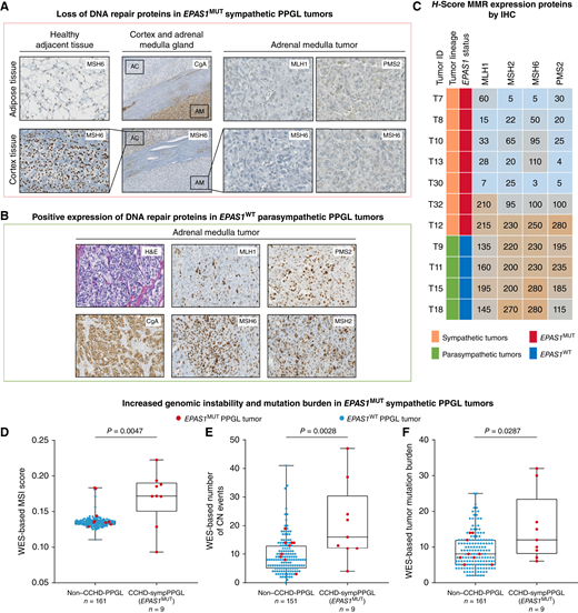 Impaired DNA repair and increased mutation burden in systemic hypoxia-developed tumors. A, IHC staining showing decreased expression of DNA repair machinery proteins observed in most EPAS1MUT sympathetic PPGL tumors from patients with CCHD (7/9, 77,7%). Results of EPAS1MUT sympathetic PPGL tumor T7 are shown: (i) expected positive expression of the MSH6 MSI biomarker in PPGL tumor-surrounding tissues from patients with CCHD, such as adipose and adrenal cortical (40× magnification); (ii) positive expression of chromogranin A in the adrenal medulla (PPGL tumor) and not cortex; (iii) positive expression of MSH6 in the adrenal cortex but not in the PPGL tumor (10× magnification), and (iv) decreased expression of MSI biomarkers such as MLH1, MSH2, MSH6, and PMS2 in the CCHD-PPGL neoplastic cells (40× magnification). B, When compared with PPGL parasympathetic tumor with EPAS1WT status (T18), all MSI biomarkers show a positive expression in the non-neoplastic and neoplastic cells. Hematoxylin and eosin and chromogranin A are also indicated as positive controls. C, IHC from MSI biomarkers in available tumor samples, scored semiquantitatively using an H-score for the nucleus. PPGL sympathetic tumors have a diminished H-score (<100; 6/7, 86%), whereas all parasympathetic tumors present higher H-scores, indicating differences of mismatch repair protein (MMR) expression between tumor linages. Detailed IHC images are shown in Supplementary Fig. S9, which include seven sympathetic PPGL tumors. A total of nine sympathetic PPGL tumor samples were analyzed; in two of them, only the PMS2 marker was assessed due to limited sample availability (T3: H-score = 1, T4: H-score = 75), and their images are not shown. D–F, Germline:tumor-paired WES data were used to compare MSI score, CN alterations burden (number of CN events), and TMB between sympathetic PPGL (sympPPGL) tumors from patients without and with CCHD (N = 161, left, and N = 9, right, respectively; refs. 61, 85). P values calculated using Mann–Whitney U test. Red circle: EPAS1MUT tumors and blue circle: EPAS1WT. CN, copy Number; H&E, hematoxylin and eosin; IHC, immunohistochemistry; MMR, mismatch repair; MSI, microsatellite instability; WES, whole-exome sequencing.
