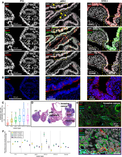 Multimodal Spatial Profiling Reveals Immune Suppression and Microenvironment Remodeling in ...