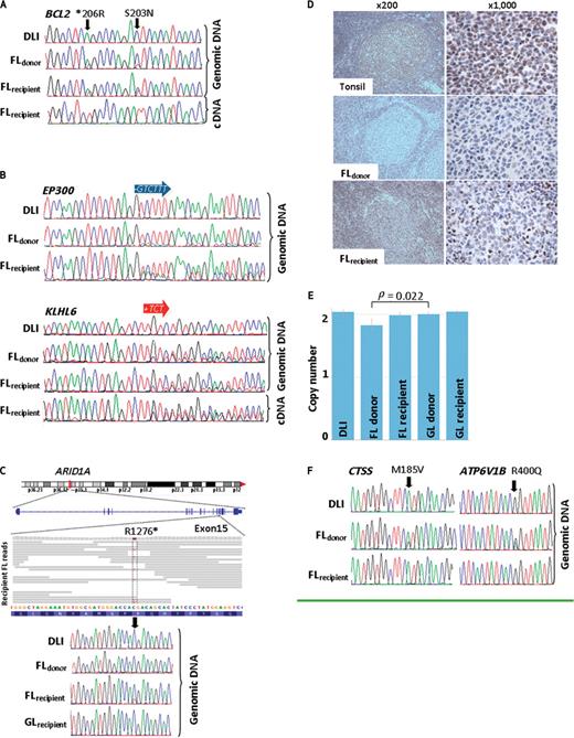 Figure 3. Mutations in the paired follicular lymphomas. A, two single nucleotide variants were present in BCL2 in both follicular lymphomas (FL) but not detectable by Sanger sequencing in the donor lymphocyte infusion (DLI). Only the mutant allele is present in cDNA from the recipient's follicular lymphoma. B, an in-frame deletion in EP300 and an in-frame insertion in KLHL6 were detectable by Sanger sequencing in both lymphomas. In contrast with BCL2, both the wild-type and mutated alleles of KLHL6 were expressed in the recipient's follicular lymphoma. C, exome sequencing reads spanning ARID1A R1276 in the recipient's follicular lymphoma are shown. The single nucleotide variant was only detectable in the recipient's follicular lymphoma. GL, germline. D, immunohistochemistry for ARID1A/BAF250 (Santa Cruz) is shown in both lymphomas and a tonsil from a healthy individual. Supplementary Figure S4B shows similar findings using a different anti-BAF250 antibody and normal control. E, quantitative PCR copy number assay at the ARID1A locus. The statistically significant decrease was confirmed in repeated iterations of this experiment. F, single nucleotide variants in CTSS and ATP6V1B were detectable by Sanger sequencing only in the donor's follicular lymphoma. Both were enriched in the donor lymphocyte infusion on the basis of ultra-deep sequencing and CTSS M185V was also present in 4.7% of reads from the recipient's follicular lymphoma.