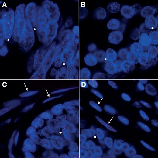 Figure 1. Telomere-specific FISH in prostate adenocarcinomas. A–D, examples of telomere length and cell-to-cell variability in telomere length in malignant and benign prostate tissue from men in the HPFS who were surgically treated for clinically localized prostate cancer. A, this case has strikingly variable telomere signals among the cancer cells. B, this case has extremely short telomere signals and low variability in telomere length from cancer cell to cancer cell. C, this case has weak telomere signals in the CAS cells. D, this case has strong telomere signals in CAS cells. In all of the images, the DNA is stained with DAPI (blue) and telomere DNA is stained with the Cy3-labeled telomere-specific peptide nucleic acid probe (red). Of note, the centromere DNA, stained with the FITC-labeled centromere-specific peptide nucleic acid probe, has been omitted from the image to emphasize the differences in the telomere lengths. In all panels, the asterisks highlight the cancer cells and the arrows point to the CAS cells. Original magnification ×400.