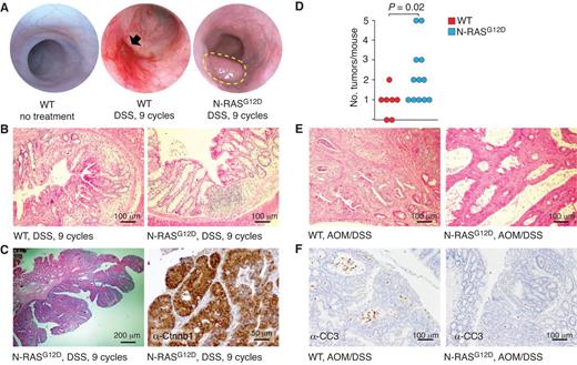 Figure 1. Mutant N-RAS promotes colon cancer in the context of inflammation. A, colonoscopy images from mice before and after 9 cycles of DSS. WT and N-RASG12D colons looked identical before treatment. After 9 cycles of DSS, WT animals developed severe colitis, which was often associated with bleeding ulcers (black arrow), but never developed tumors. After the same period, 50% of N-RAS mutant animals developed colonic tumors (outlined in yellow). B, histologic analysis of tissue damage in WT and N-RAS mutant animals after 9 cycles of DSS. The WT animals exhibited more significant tissue damage. C, histologic analysis of colonic tumors from animals expressing N-RASG12D. These tumors were adenocarcinomas with high-grade dysplasia. The lesions were strongly positive for nuclear β-catenin (Ctnnb1). D, colonic tumor multiplicities from animals treated with AOM and DSS. WT animals (n = 7) developed, on average, 0.85 tumors per animal, whereas N-RAS–mutant animals (n = 12) developed, on average, 2.25 tumors. (P = 0.02, Wilcoxon rank-sum test). E, histologic analysis of tumors from AOM/DSS-treated animals. No clear difference was found between WT and N-RAS mutant tumors. F, immunohistochemical detection of apoptosis in AOM/DSS tumors. Tumors expressing WT N-RAS exhibited a greater number of cells positive for cleaved caspase-3 (CC3).