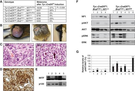 Figure 3. Nf1 and Braf mutations cooperate to promote melanomagenesis in mice. A, genotypes and tumor phenotypes of experimental animals and control groups. B, pictures showing tumors from tamoxifen-treated Tyr::CreERT2; BrafCA/+; Nf1flox/flox mice. Note the pigmented area on the surface of the tumor (left), the presence of more than one lesion (middle), and the remarkable thickening of the tail (right). C and D, representative histologic images (×400 magnification) of tumors from tamoxifen-induced Tyr::CreERT2; BrafCA/+; Nf1flox/flox mice. C, tumor sections are stained with H&E. Tumors show marked cytologic atypia and pleomorphism, including bizarre cells with irregular chromatin distribution and irregular nuclear outlines (left). Occasionally, melanophages containing extensive brown pigment were observed (right). D, the vast majority of neoplastic cells stain positive for S100. E, MITF protein expression in primary tumor tissue from tamoxifen-treated Tyr::CreERT2; BrafCA/+; Nf1flox/flox mice was confirmed by immunoblotting. F, protein levels of NF1, phospho-AKT, and phospho-ERK in distinct tumors from tamoxifen-induced Tyr::CreERT2; BrafCA/+; Nf1+/+ (left) and Tyr::CreERT2; BrafCA/+; Nf1flox/flox (right) mice, as determined by immunoblotting. Relative phospho-AKT levels are quantified in G.