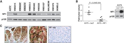 Figure 5. NF1 protein expression in human melanomas. A, NF1 protein levels in a panel of 11 human melanoma cell lines, as determined by immunoblotting. Four lines (with asterisks) exhibit low or no NF1 expression. Three lines (underlined) harbor NF1 mutations. B, NF1 reconstitution in A375 cells potently suppresses the growth of xenografts in mice. Tumor size is shown on left, protein expression on right. C, tissue microarray analysis of NF1 in human malignant and metastatic melanomas. Positive NF1 staining in nevus is shown on left. A magnification of the inset box is shown in the middle. Negative NF1 staining in human melanoma is shown on the right.