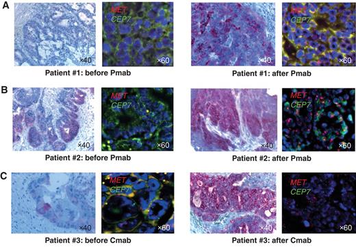 Figure 2. MET amplification is selected in KRAS wild-type colorectal cancer samples from patients who developed resistance to anti-EGFR treatment. FISH analysis showing amplification of the MET gene in formalin-fixed paraffin embedded (FFPE) tissue sections from 3 patients with colorectal cancer (#1, #2, and #3; A–C) who developed resistance to therapy with the anti-EGFR monoclonal antibodies panitumumab (Pmab) or cetuximab (Cmab). MET (7q31)–specific probe is labeled with Texas red, whereas chromosome 7 centromeric probe D7Z1 (7p11.1–q11.1) is marked in green. IHC staining for MET is shown in the left of each panel. FISH, original magnification ×60; IHC, original magnification ×40.