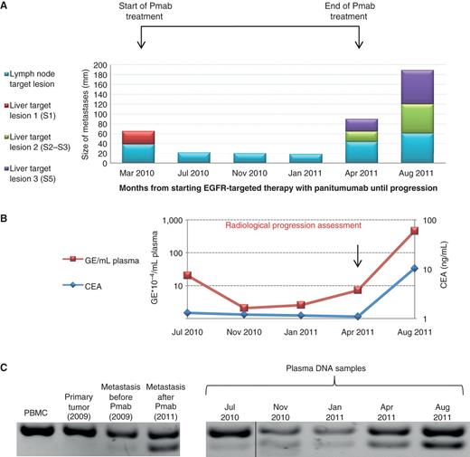 Figure 3. Monitoring MET amplification in circulating tumor DNA during anti-EGFR therapy. A, size of liver metastases at segment 1 (S1; red), segments 2 to 3 (S2–S3; green), and segment 5 (S5; violet) and of lymph node target lesions at the hepatoduodenal ligament (cyan) during panitumumab (Pmab) therapy in patient #2 at the indicated time points, showing response to panitumumab followed by progression. B, carcinoembryonic antigen (CEA) levels (blue line) and number of genome equivalent (GE; red line) obtained from 1 mL of plasma from patient #2, as assessed by real-time PCR. C, DNA electrophoresis of PCR products using primers designed to detect the presence of the MET-associated amplified rearrangement on chromosome 7. The bottom band corresponds to an 89-bp tumor-specific PCR product, which is positive only when the rearrangement is present. A control assay detecting the wild-type locus generated amplicon of 124-bp (top band) is also shown.