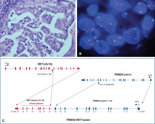 Figure 1. A, photomicrograph of a supraclavicular lymph node biopsy showing a lung adenocarcinoma with papillary morphology. B, a positive RET FISH break-apart test. Split green and red signals indicate the presence of a RET fusion. Probes were designed as previously published (13). C, the presumptive t(1;10)(p13;q11.2) translocation places TRIM33 exons 1 to 14 upstream of RET exons 12 to 18, generating an in-frame TRIM33–RET fusion gene.