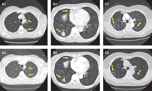 Figure 2. A1, baseline chest CT of the first patient with TRIM33–RET showing paramediastinal and pleural-based nodularities in the left upper lobe. A2, repeat imaging after 4 weeks of therapy revealing the disappearance of paramediastinal disease and a significant reduction of pleural-based disease. B1, chest CT of the second RET fusion-positive patient showing 2 nodules in the right lower lobe. B2, decrease in both size and solid components of both lesions at 4 weeks. C1, baseline imaging of the third patient with KIF5B–RET showing small bilateral pulmonary nodules. C2, stable disease at 4 weeks. All responses have been confirmed at 12 weeks and have since been maintained clinically and radiographically. Baseline disease burden was relatively low for all 3 cases.