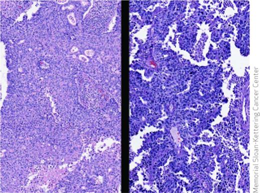 Pathologists don't always agree on whether an endometrial cancer should be categorized as a grade 3 endometrioid tumor (left) or a serous tumor (right), but the distinction drives treatment choices. Molecular analysis of tumors shows that about 25% of high-grade endometrioid tumors have a molecular phenotype similar to serous tumors, suggesting that genomic-based classification of tumors may alter therapeutic decisions and improve patient outcomes.