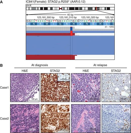 Figure 4. Subclonal presence of STAG2 mutations. A, Integrative Genomics Viewer representation showing the subclonal presence of STAG2 mutations in one sample. B, evolution of STAG2 staining between diagnosis and relapse in two independent cases. Whereas only a small subset of tumor cells lacked STAG2 expression at diagnosis (see insets), the tumor cells were homogeneously negative at relapse. The few STAG2-positive stromal cells serve as an internal positive control.