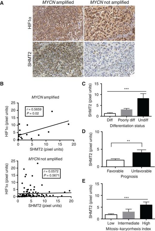 Figure 6. Expression of SHMT2 and HIF1α correlate in aggressive neuroblastomas. Human neuroblastoma microarray with 123 tumor samples in duplicates were stained for SHMT2 and HIF1α, staining was quantified using the Matlab software. A, representative images of HIF1α and SHMT2 (×40) from MYCN-amplified or MYCN-nonamplified neuroblastoma samples. B, SHMT2 and HIF1α staining correlate in MYCN-amplified tumor samples, but notin tumors without MYCN amplification. C to E, SHMT2 expression significantly correlates with tumor dedifferentiation and poor prognosis. C, ANOVA,***, P < 0.001. D, Student test, **, P < 0.01. E, ANOVA, ***, P < 0.001.