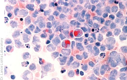 Researchers have identified ancestral pre-leukemic hematopoietic stem cells that may give rise to acute myeloid leukemia, shown here.