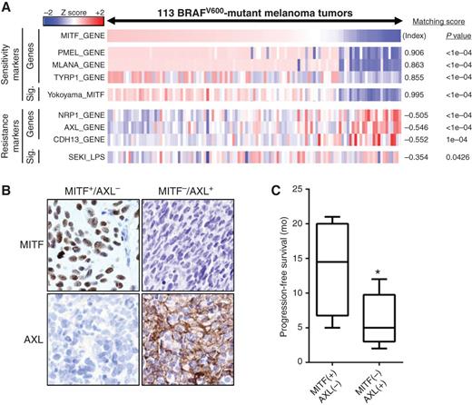 Figure 2. MITF-low/NF-κB–high transcriptional class is present and associated with resistance to MAPK pathway inhibition in human tumors. A, transcriptional class distinction in BRAFV600-mutant melanoma tumor samples. B, examples of AXL and MITF staining in pretreatment melanoma biopsies (magnification, ×40). C, comparison of progression-free survival between MITF-positive/AXL-negative and MITF-negative/AXL-positive classes. *, P = 0.0313, two-tailed t test.