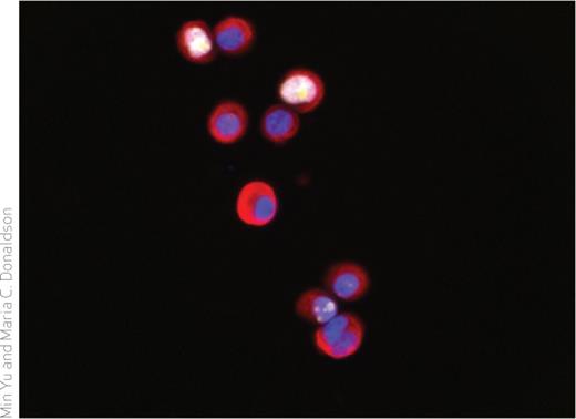 CTCs isolated and cultured from the peripheral blood of a patient with breast cancer. Cytokeratin is shown in red; Ki67 in yellow; CD45 in green; and nuclei in blue.