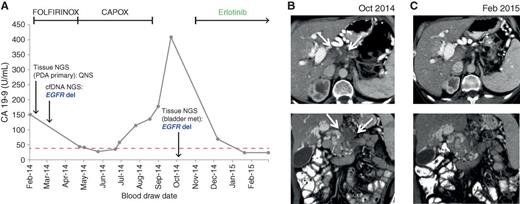 Figure 3. Treatment and diagnosis history, and response to targeted therapy, of a patient with pancreatic adenocarcinoma with an EGFR exon19 deletion. A, CA 19-9 levels (x-axis) over time of treatment (y-axis) for patient #34. Dates of two biopsy-based NGS tests, and of EGFR indel detection by cfDNA test, are indicated along the CA 19-9 line. Time intervals for therapies administered to patient are indicated by bracketed lines at top. Erlotinib monotherapy is ongoing as of June 3, 2015. B, axial (top) and coronal (bottom) contrast-enhanced CT images from October 2014 demonstrate infiltrative tumor (arrows) arising from the pancreatic body and encasing the celiac axis. C, axial (top) and coronal (bottom) contrast-enhanced CT images from February 2015 demonstrate marked reduction in the size of the pancreatic mass. FOLFIRINOX, Leucovorin Calcium (Folinic Acid), Fluorouracil, Irinotecan Hydrochloride, Oxaliplatin; CAPOX, Capecitabine and Oxaliplatin.