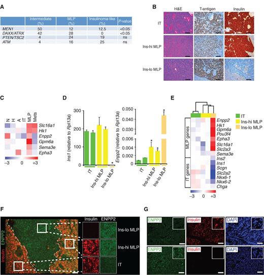 Figure 3. Mutation changes and biomarker expression in human and mouse PanNET subtypes. A, a summary of MEN1, DAXX/ATRX, mTOR pathway (PTEN/TSC2) and ATM gene mutations in human PanNET subtypes. P values correspond to the Fisher exact test. ns, not significant. B, visualization of different histologic subtypes of RT2 tumors with hematoxylin and eosin (H&E) staining, and immunostaining for the driving oncoprotein (SV40 T-antigen) and insulin. Images are representative of the analysis from 60 tumor-bearing RT2 B6, B6AF1, and B6D2F1 mice (see Methods section for different strains of the RT2 mouse model). Scale bar, 200 μm. C, heatmap showing median expression of MLP-specific genes (biomarkers) in distinct stages of the RT2 mouse model of PanNET. N, normal islet; H, hyperplastic/dysplastic islet; and A, angiogenic islet. D and E, expression of PanNET subtype genes in five different laser capture microdissection–derived (LCMD) samples from tissue sections of tumors representing IT, Ins-hi MLP, and Ins-lo MLP subtypes using (D) RT-PCR (Ins1 and Enpp2) and (E) microarray (multiple PanNET subtype genes) methodologies. In D, * represents statistical P value < 0.05 as measured using the Student t test comparing relative Ins1 or Enpp2 expression in IT versus Ins-hi and Ins-lo MLP tumors. F, visualization of different histologic subtypes of RT2 tumors within a single pancreas by immunostaining for ENPP2 and insulin protein expression. Images are representative of the analysis from 8 tumor-bearing RT2 mice. Scale bar, 50 μm. G, ENPP2 and insulin protein expression in human PanNETs as assessed using IHC. DAPI (4′,6-diamidino-2-phenylindole) staining represents cellular nucleus. Scale bar, 50 μm.