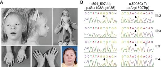 Figure 1. An individual with early-onset breast cancer, clinical features of Fanconi anemia, and biallelic BRCA1 mutations. A, the affected individual at 3 and 23 years old showing hypertelorism, epicanthal folds, ptosis, strabismus, blepharophimosis, broad nasal bridge and nasal tip, and proximally inserted thumbs. B, sequencing of BRCA1 in family members demonstrated that both BRCA1 alleles in the proband were inherited from the heterozygous parents. III: 2, proband; III: 3, brother; II: 3, father; II: 4, mother.
