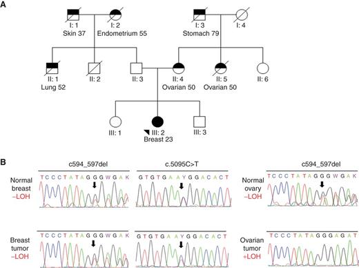 Figure 2. Pedigree and LOH analysis of proband breast cancer. A, pedigree with all known cancer diagnoses in the family. Black triangle represents the proband. B, LOH analysis by Sanger sequencing of genomic DNA extracted from paraffin-embedded tumor blocks. Breast tumor was derived from the proband (III: 2), and ovarian cancer was derived from the mother (II: 4). Cancer cells and control noncancer cells were isolated and enriched by laser-capture microdissection.