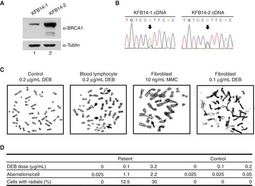 Figure 3. Characterization of BRCA1 function in the proband-derived cells. A, immunoblot for BRCA1 from fibroblast cell lysates shows reduced BRCA1 expression in the proband compared with the heterozygous sibling. KFB14-1, fibroblast cells derived from the proband III: 2. KFB14-2, fibroblast cells derived from the sibling III: 3. B, RT-PCR followed by cDNA sequencing showed that approximately 80% of BRCA1 mRNA in KFB14-1 cells contains the p.Arg1699Trp mutation, whereas approximately 50% of BRCA1 mRNA in KFB14-2 cells is WT. C, examples of metaphase chromosomes from peripheral blood lymphocytes [treated with 0.2 μg/mL diepoxybutane (DEB)] and fibroblast KFB14-1 cells (treated with 10 ng/mL MMC or 0.1 μg/mL DEB). Arrows, radial chromosomes or chromatid breaks. D, quantification of abnormal chromosomes in chromosome breakage tests from peripheral blood samples of the proband and sibling.