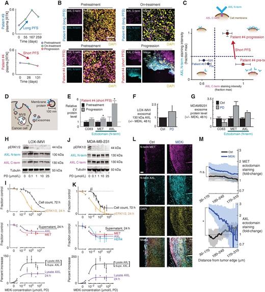 Figure 2. Decreased circulating AXL correlates with increased AXL surface levels in the tumor after MEKi. A, longitudinal plasma RTK levels monitored in patients with melanoma showing similar initial response to MAPKi (Supplementary Fig. S2A) but dramatically different PFS. B, immunofluorescence of AXL cytoplasmic domain (C-term) and ectodomain (N-term) from tumor biopsies from patients in A. C, schematic of AXL measurements and quantification of data from B. D, multivesicular bodies (MVB) generate exosomes containing membrane proteins resembling those on the cell surface. E, levels of MET, AXL, and the exosome marker CD63 on EVs isolated from plasma from patient #4 before treatment and after disease progression (nPLEX; *, P= 0.008, n = 8, two-tailed t test). F, levels of full-length AXL on exosomes isolated from LOX-IMVI cells in culture (Western blot; n= 3). G, levels of MET, AXL, and the exosome marker CD63 on exosomes isolated from MDA-MB-231 cells ± MEKi treatment (nPLEX; *, P= 0.01, n≥ 2, two-tailed t test). H, LOX-IMVI lysate Western blot, probed with Abs for AXL ectodomain (N-term) and cytoplasmic (C-term) epitopes. I, quantification of cell count, pERK1/2, and RTK levels in LOX-IMVI cells (n≥ 3). Supe., supernatant. J, MDA-MB-231 lysate Western blot, probed with Abs for AXL ectodomain (N-term) and cytoplasmic (C-term) epitopes. K, quantification of cell count, pERK1/2, and RTK levels in MDA-MB-231 (n≥ 3). L, representative immunofluorescence of LM2 primary TNBC tumors 21 days after PD325901 treatment, showing upregulation of AXL ectodomain near the tumor edge. Scale bar, 100 μm. M, mean (thick line) ± SEM (shaded area) for staining intensity for MET and AXL measured within a 140-μm sliding window from the tumor edge (*, P= 0.013; n≥ 3 tumors per group).
