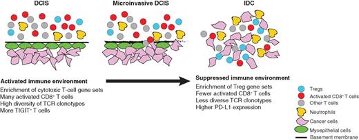 Figure 6. Schematic model. Major changes in cell types and their activity during DCIS to IDC progression.