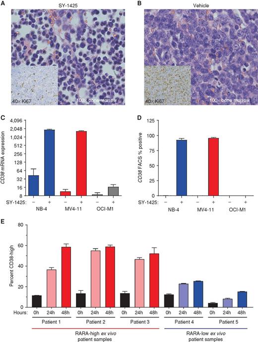 Figure 5. SY-1425 induces maturation in RARA-high AML. A and B, Histology from bone marrow for (A) SY-1425 treated and (B) vehicle treated. H&E staining of bone marrow from mice at day 14 of treatment shown at 100×. Inset on each image is Ki67 staining from the same bone marrow and time at 40×. C, CD38 mRNA expression analyzed by microarray in an APL cell line (NB-4; blue), a RARA-high cell line (MV4-11; red), and a RARA-low cell line (OCI-M1; gray). Error bars represent standard deviation of 3 biological replicates. D, CD38 protein expression analyzed by flow cytometry in an APL cell line (NB-4; blue), a RARA-high cell line (MV4-11; red), and a RARA-low cell line (OCI-M1; gray). Error bars represent standard deviation of 3 biological replicates. E, Plot of CD38-high induction for 3 RARA-high patients (left, red) and 2 RARA-low patients (right, blue) at indicated time points. Samples were mononuclear cells from patients with AML tested for ex vivo response to 50 nmol/L SY-1425.