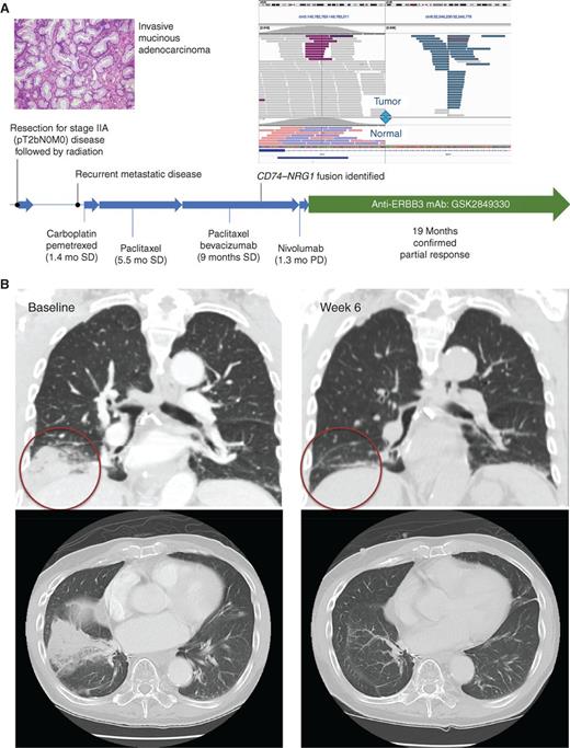 Figure 1. Clinical response to anti-ERBB3 mAb therapy in a patient with an advanced NRG1-rearranged non–small cell lung cancer. A, A never-smoker with advanced invasive mucinous adenocarcinoma was treated with several lines of systemic therapy (chemotherapy and immune therapy) with no response to any of these treatments. His tumor was subsequently found to harbor an in-frame CD74–NRG1 fusion that includes the EGF-like extracellular domain that serves a binding site for ERBB3. Targeted therapy with GSK2849330, an anti-ERBB3 monoclonal therapeutic antibody, was initiated on a phase I clinical trial. B, A durable (19 months) and confirmed partial response (RECIST version 1.1) was achieved that exceeded the duration of disease control achieved on all prior systemic therapy regimens in aggregate. Substantial disease shrinkage of a right lower lobe mass was noted early (by week 6 as shown; circled) in the course of therapy. SD, stable disease; PD, progressive disease.