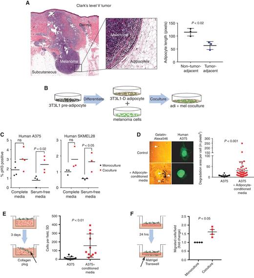 Figure 1. Tumor-adjacent adipocytes contribute to melanoma progression. A, Hematoxylin and eosin staining on a Clark's level V tumor. Vertical growth in the tumor (Mel) exposes melanoma cells to dermis as well as subcutaneous tissues, which is mainly composed of adipocytes. The graph shows quantification of maximum length of tumor-adjacent adipocytes and non–tumor-adjacent adipocytes. Each data point represents the average length of 10 to 15 tumor-adjacent and 10 to 15 non–tumor-adjacent adipocytes for 3 regions of interest in section. Error bars, SD. Two-tailed unpaired t test. B, Schematic showing the adipocyte–melanoma coculture system. C, Phosho-H3 staining in SKMel28-GFP and A375-GFP cells cocultured with 3T3L1 adipocytes for 24 hours. %pH3 was calculated by counting the number of pH3+ nuclei over total number of GFP+ cells/field. Each data point represents an average of >10 fields/condition. Two-tailed unpaired t test; n ≥ 3 independent experiments. D, Gelatin degradation assay to measure invasive capacity of A375-GFP cells. A375-GFP cells were seeded on gelatin matrix and grown in control media or adipocyte-conditioned media for 24 hours. Degradation was calculated as the area of degraded gelatin as a proportion of the total cell area. Representative images are shown. Error bars, SD. T test with Welch correction; n = 3 independent experiments. Scale bars, 10 μm. Arrowheads indicate areas of degradation. E, A375-GFP were seeded on top of collagen-polymerized matrix and allowed to invade for 3 days. Quantification was done counting the number of cells invaded 30 to 60 μm into the collagen matrix per field (black arrow). Error bars, SD. Two-tailed unpaired t test with Welch correction; n = 3 independent experiments. F, Matrigel Transwell migration of FACS-isolated A375-GFP cells in monoculture or after coculture with 3T3L1 adipocytes for 7 days. Quantification was done counting the number of cells on the bottom side of the Transwell (black arrow) calculated as the fold change of number of cells in cocultured cells compared with monoculture controls. Each data point represents an average of ≥3 fields/condition per independent experiment. Two-tailed unpaired t test with Welch correction; n = 4 independent experiments.
