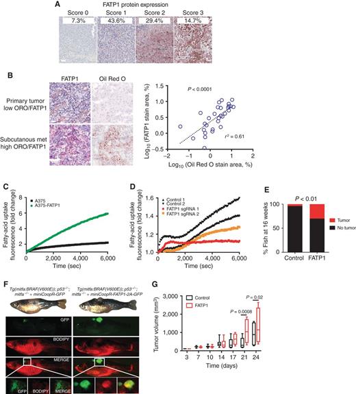 Figure 6. Aberrantly expressed FATP1 mediates lipid uptake in human melanomas. A, Immunohistochemistry images of endogenous FATP1 in a panel of 105 clinically defined human melanoma tumor samples. Representative images are shown. Score 0 represents no FATP staining, scores 1 and 2 represent low–medium FATP staining, and score 3 represents high FATP staining. Scale bar, 100 μm. B, Immunohistochemistry images of low FATP1 expression and Oil Red O (ORO) staining in a primary tumor and high FATP1 expression and ORO staining in a subcutaneous metastasis. Graph shows correlation of FATP1 expression and ORO staining in 7 patient samples consisting of one primary tumor and six subcutaneous and nonsubcutaneous metastases. r2 based on Spearman rank-order correlation coefficient. Scale bar, 100 μm. C, QBT real-time lipid uptake in A375-overexpressing FATP1 compared with control cells. Graph represents mean from 3 independent experiments. Area under the curve (AUC) was calculated for each curve, and differences were compared by 95% confidence intervals. D, QBT timed lipid uptake in A375 FATP1 CRISPR knockout cells compared with control cells. Graph represents mean from 3 independent experiments. AUC was calculated for each curve, and differences were compared by 95% confidence intervals. sgRNA 1 and 2 had 73% and 55% mutant reads, respectively, validated via sequencing. E, MiniCoopR-EGFP or MiniCoopR-FATP1 was injected into Trp53/BRAF/Nacre embryos. Percentages indicate melanoma incidence at 16 weeks of age, and statistical differences in tumor incidence were quantified with Chi-square test. F, MiniCoopR-EGFP or MiniCoopR-FATP1 fish were stained with BODIPY-RED to visualize lipid burden in GFP+ tumor regions. Representative images are shown. G, Tumor volumes over time of nude mice harboring A375-mCherry or A375-FATP1-mCherry subcutaneously xenografted tumors. Error bars, SD. n = 5 individual xenograft mice per group.