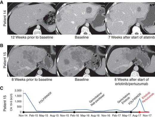 Figure 3. Response to targeted therapy in 2 patients with PDAC harboring NRG1 fusions. A, CT scans showing tumor growth prior to afatinib therapy and response of liver metastases to afatinib after 7 weeks of treatment in patient 14. Baseline CT scans were taken before the start of afatinib therapy. B, CT scans showing initial growth during FOLFIRINOX treatment and response of liver metastases to erlotinib/pertuzumab combination therapy after 8 weeks in patient 15. C, Time course of serum CA 19-9 levels in patient 15 showing initial response to FOLFIRINOX and disease stabilization under subsequent therapies as well as rapid progression during retreatment with FOLFIRINOX. Decline of serum CA 19-9 levels to normal values was observed with erlotinib/pertuzumab therapy (indicated in red).