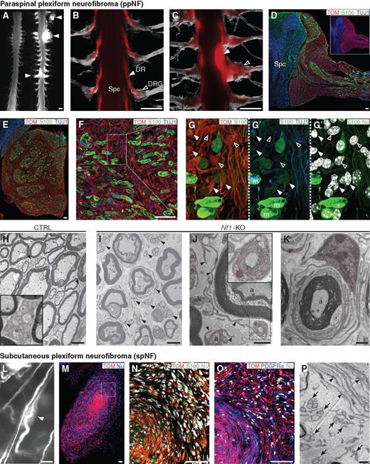 Figure 2. Targeted Nf1 inactivation in the BC cell lineage gives rise to paraspinal and subcutaneous pNFs. A, Global view of control (left) and Nf1-KO mutant (right) spinal cords with attached nerve roots from 11-month-old animals. Paraspinal tumors are present in the mutant at the cervical and thoracic levels (arrowheads). B and C, Higher magnifications of the control (B) and Nf1-KO-mutant (C) thoracic regions showing enlargement of the mutant nerve roots (full arrowheads) and adjacent DRGs (empty arrowheads) caused by accumulation of TOM+ cells. D, Section through this region showing compression of the spinal cord by the TOM+/S100+ tumor mass. E–G″, Increasing magnifications through a neurofibroma immunolabeled for TOM, S100, and TUJ1. Strongly S100+ mSCs (always in contact with large-caliber axons) are intermixed with randomly organized TOM+ cells that are weakly S100+ (full arrowheads in G–G′′) or S100− (empty arrowheads in G–G′′). Ultrastructure analysis of control (H) and Nf1-KO (I–K) nerve roots revealed an enlargement of the extracellular compartment and disruption of Remak bundles (arrowhead) in the mutant. Normal Remak SCs are shown in H (arrowhead and inset). Mutant nmSCs ensheath fewer axons or are devoid of axonal contact and extend slender protrusions that enwrap collagen fibrils (J) or myelinated fibers (K). nmSCs are pseudocolored in red in (H, J, and K). L, Subcutaneous nerve showing the local enlargement corresponding to a subcutaneous plexiform NF (spNF; arrowhead). M–O, Sections through an spNF immunolabeled for TOM, S100, and PDGFRα (fibroblasts) reveal expansion of traced SCs and nontraced fibroblasts. N–O correspond to the boxed area in M. P, Electron microscopy micrograph of the spNF shows disrupted Remak bundles (arrows) and abnormal perineurial sheath (arrowheads). Spc, spinal cord; DR, dorsal root; DRG, dorsal root ganglion; m, myelinating Schwann cell: a, axon. Scale bars, 1 mm (A–C, L), 50 μm (D–F, M–O), 1 μm (H–K, P).