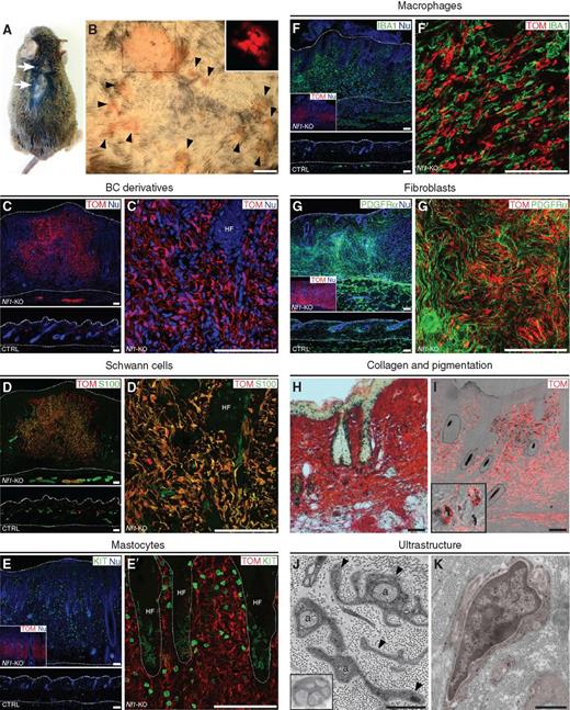 Figure 3. Mice with Nf1 loss of function in BC cell derivatives develop diffuse cutaneous NFs. A, 19-month-old Nf1-KO mutant showing pruritic skin lesions (arrows) at cervical and thoracic levels. B, Numerous small lesions present on the back skin (arrowheads) showing direct TOM fluorescence (inset). C–G′, IHC analysis of cNF reveals accumulations of TOM+/S100+ SCs with aberrant morphologies (C, D′), and heavy infiltration of KIT+ mastocytes (E, E′), IBA1+ macrophages (F, F′) and PDGFRα+ fibroblasts (G, G′). Control skin is shown on the bottom left of each figure. Insets in E–G represent low magnifications of the corresponding images with TOM labeling. Dotted lines indicate the upper tissue limits and the boundaries between dermis and hypodermis. KIT staining within hair follicles (HF) in C′ corresponds to melanocytes. H, Dense collagen accumulation in cNF revealed by sirius red staining (red). I, Extrafollicular pigmentation in cNF. The inset shows higher magnification of TOM+ and TOM− pigmented cells (dark granules). Dotted lines encircle hair follicles containing pigmented hair shafts. J and K, Electron microscopy micrographs showing SC cytoplasmic protrusions (arrowheads in J) unsheathing isolated axons (a) and/or collagen fibrils (inset in J). K, Immunoelectron micrograph of mutant SC (pseudocolored in red) without axonal contact at the level of the soma. Dark granules correspond to TOM staining. Scale bars, 5 mm (B), 100 μm (C–I), 1 μm (J, K).