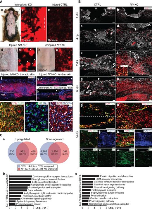 Figure 6. Skin injury promotes development of cNFs in Nf1-KO mice. A, Comparison of Nf1-KO and control skin at 7 months after injury. (a) Dorsal skin from a 10-month-old injured Nf1-KO mutant with multiple discrete skin (pale spots) and crusty lesions (arrowheads) all over the back skin. (b, c) Distribution of TOM+ cells in the thoracic skin of 10-month-old Nf1-KO mutant (b), and control (c) injured mice (dotted line indicates the site of incision). (d–e′) Lumbar skin from a 10-month-old injured Nf1-KO mouse (d, d′) and an age-matched uninjured Nf1-KO mutant (e, e′). Note in (d) the presence of numerous pale spots (arrowheads). (d′, e′) Higher magnification of the lumbar skin with direct TOM fluorescence. Arrowheads indicate aggregates of TOM+ cells, related to pale spots in (d). (f–h) Transverse sections through thoracic (f) and lumbar (g) skin from the injured Nf1-KO animal and lumbar skin from the uninjured mutant (h). Dense accumulations of TOM+ cells are observed in the dermis, both at sites close to (f) and distant from (g; arrowheads) the injury. The skin from uninjured Nf1-KO contains only microscopic lesions, corresponding to micro-cNFs (arrowhead in h and magnified view in the inset). (i–k) Injury sites show a cell composition typical of cNFs, with accumulation of TOM+/S100+ SCs with aberrant morphologies (i), KIT+ mastocytes, IBA1+ macrophages (j) and PDGFRα+ fibroblasts (k). Dotted line in f–h, boundary between dermis and hypodermis. B, Time-course analysis of wounded control (CTRL) and Nf1-KO skin. (a–h) Tracing of wild-type (a, c, e, g) and Nf1-KO (b, d, f, h) TOM+ SCs at 2, 4, 7, and 14 day after injury (dpi). The arrowheads indicate the injury site. Inset in (f) shows coexpression of TOM and proliferation marker PH3. Nu; nuclear staining. (g′, h′) High-magnification images of (g) and (h) showing TOM and axonal (TUJ1) staining. (i–p) Immunolabeling of control (i, j, m, n) and Nf1-KO (k, l, o, p) wound sites for S100 (SCs; i, k), PDGFRα (fibroblasts; j, l), IBA1 (macrophages; m, o), and KIT (mastocytes; n, p). Scale bars, 5 mm (A-b, c, d′, e′), 500 μm (A-f–h), 50 μm (A-i–k), 100 μm (B). C, Differentially expressed genes between injured and uninjured skin and pathway enrichment analysis. (a) Significantly upregulated and downregulated genes (P < 0.05 and FC > 4) between injured (14 dpi) and uninjured skin in control and Nf1-KO animals. (b, c) Top-ranked enriched KEGG pathways among the upregulated genes in injured versus uninjured comparisons in Nf1-KO (b) and control (c) skin.