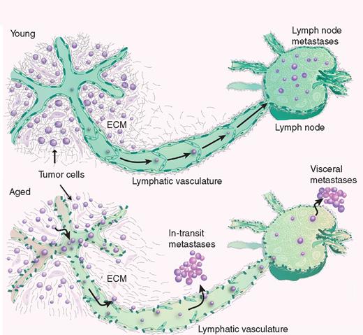 Figure 6. Schematic representation of age-dependent changes in melanoma tumor progression. Age-related changes in the perilymphatic stroma impair the integrity of lymphatic vessels and nodes and increase lymphatic permeability. Such differences may underlie the clinical observations of increased rates of in-transit disease and false-negative sentinel lymph node biopsies.