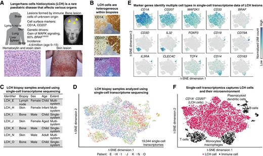 Figure 1. Single-cell transcriptome analysis captures cellular and molecular diversity of LCH lesions. A, Clinical presentation and incidence of LCH. Shown is an X-ray image of LCH bone lesions in the skull (top right), a photograph of extensive LCH skin lesions (bottom right), and a hematoxylin and eosin staining of an LCH biopsy (bottom left). B, Cellular heterogeneity in an LCH biopsy (lymph node), as revealed by immunostaining for CD1A, CD207, and an antibody that specifically detects mutated BRAFV600E protein. C, Overview of patient biopsy samples analyzed by single-cell RNA sequencing (RNA-seq) in this study. D, Low-dimensional projection (t-SNE plot) of the combined single-cell RNA-seq dataset across all analyzed biopsies, comprising a total of 19,044 single-cell transcriptome profiles. E, Molecular heterogeneity in LCH illustrated by low-dimensional projection (as in D) of all single-cell transcriptome profiles overlaid with the expression levels of selected marker genes (dark blue color indicates high expression levels). F, Cellular heterogeneity in LCH illustrated by low-dimensional projection (as in D), annotated with cell types inferred from marker-gene expression.
