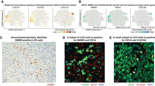 Figure 4. The cell-surface markers HMMR and CLEC9A identify specific LCH-cell subsets. A, Low-dimensional projection (t-SNE plot) of LCH-cell transcriptomes (same layout as in Fig. 3A) overlaid with the intensity of LCH subset–specific gene expression signatures (calculated as the mean scaled UMI count for all genes in the signature). Dark red color indicates high expression levels. B, Low-dimensional projection (t-SNE plot) of the LCH-cell transcriptomes (as in A) overlaid with the expression of selected LCH subset–specific marker genes (dark blue color indicates high expression levels). Expression of HMMR is specific to LCH-S1 cells, MKI67 expression overlaps strongly with both the LCH-S1 and LCH-S2 cell subsets, and CLEC9A is detected almost exclusively in LCH-S12 cells. C, IHC image of HMMR (brown) staining of an LCH biopsy. D, Immunofluorescence image of HMMR (green), CD1A (red), and DAPI (blue) staining of an LCH biopsy. E, Immunofluorescence image of CD1A (green), CLEC9A (red), and DAPI (blue) staining of an LCH biopsy.