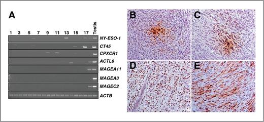 Figure 1. NY-ESO-1 expression in meningioma. A, representative ethidium bromide–stained agarose gels showing PCR amplicons from CT genes and actin, β (ACTB) as endogenous control. In all amplification assays, testis cDNA was included as control (last lane). B, IHC staining of meningioma samples using monoclonal antibodies specific to NY-ESO-1 (clone E978; shown in brown). Meningioma sections presented variable cytoplasmic and nuclear NY-ESO-1 staining, typically showing either focal and scattered positive cells (B and C) or intense and diffuse positivity (D and E) in more than 90% of tumor cells. Original magnification, ×200.
