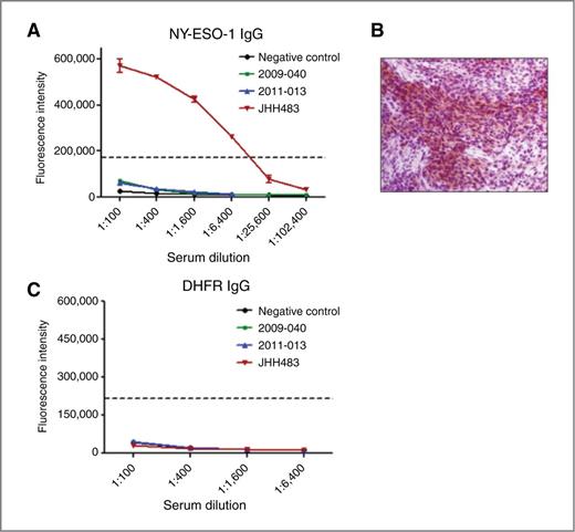 Figure 2. NY-ESO-1 autoantibody measurement in meningioma. A, representative ELISA results with 4 sera from meningioma patient samples tested in serial dilutions against NY-ESO-1 protein. B, IHC staining of JHH483 tumor sample for NY-ESO-1 (clone E978). Magnification, ×200. C, representative ELISA results with 3 sera from meningioma patient samples tested in serial dilutions against the DHFR protein (negative control). Each line represents a titration curve of a serum from a single patient. Cutoff value = 170,580 (dotted line).