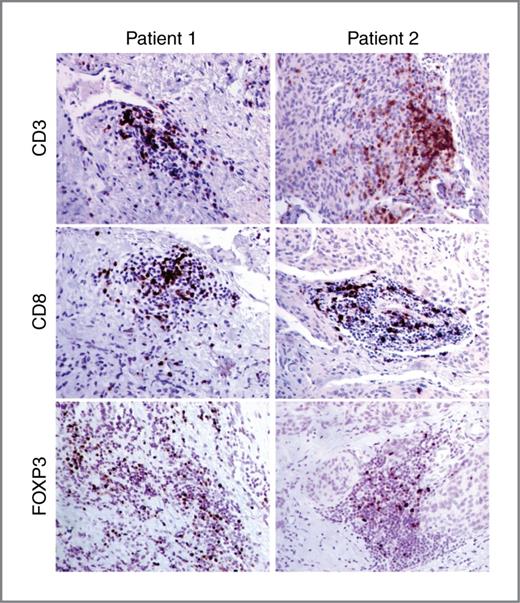 Figure 3. Characterization of TILs in meningioma samples. Representative IHC staining of meningiomas for CD3, a surface antigen of the human T lymphocyte lineage that is a pan-T-cell marker; CD8, a transmembrane glycoprotein expressed as a heterodimer by mature CTLs; FOXP3, Forkhead box protein P3 transcription factor expressed by Tregs. Magnification, ×200.