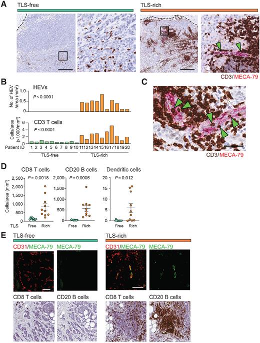 Figure 1. IHC analyses of tumor HEVs and immune-cell infiltration. A, Immunostaining of TLS-rich and TLS-free tumors for MECA-79 (magenta) and CD3 (dark brown) was performed to determine the abundance of HEVs and T cells. The dotted line shows the edge of each tumor. Arrowheads indicate the MECA-79+ HEVs. The higher magnification of each left panel (black square) is shown on the right. Scale bar, 500 µm. B, HEV and CD3+ T-cell densities were quantified in specimens of 10 patients for each tumor type (TLS-rich and TLS-free). C, Immunostaining of CD3 and MECA-79. Green arrowheads indicate several CD3+ cells on or in the endothelial wall of HEVs. Scale bar, 50 µm. D, Comparison of CD8+ T-cell, CD20+ B-cell, and DC-LAMP+ dendritic-cell densities between the two tumor groups analyzed in B. Error bar; SEM. E, Immunofluorescence detection of HEVs associated with lymphocyte clusters in TLS-rich tumors. Consecutive sections of the same tumors were stained for CD31/MECA-79 (immunofluorescence), CD8, or CD20 (dark brown) to orient the positions of immune cells and blood vessels. A representative TLS is shown here for TLS-rich tumors. CD31, EC marker (red). Scale bar, 500 µm. P value was calculated by Student t test.